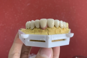 qui trình làm răng toàn sứ cad/cam zirconia