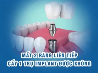 PHỤC HÌNH TRÊN IMPLANT - HAPPY DENTAL LAB