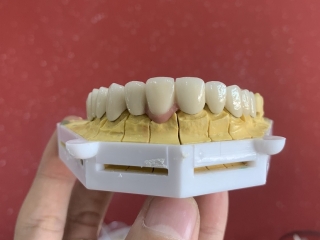 qui trình làm răng toàn sứ cad/cam zirconia